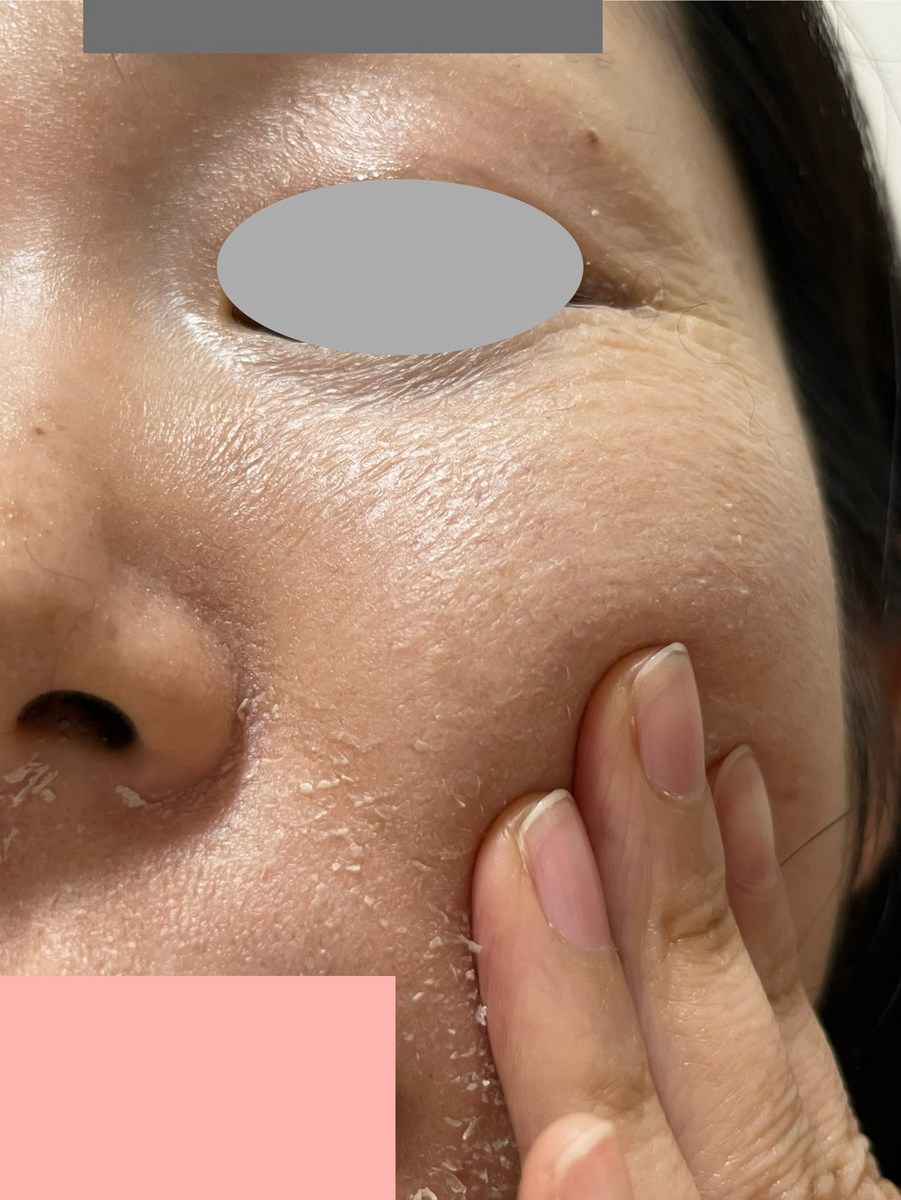 セラピューティック　皮剥け　ビニール肌