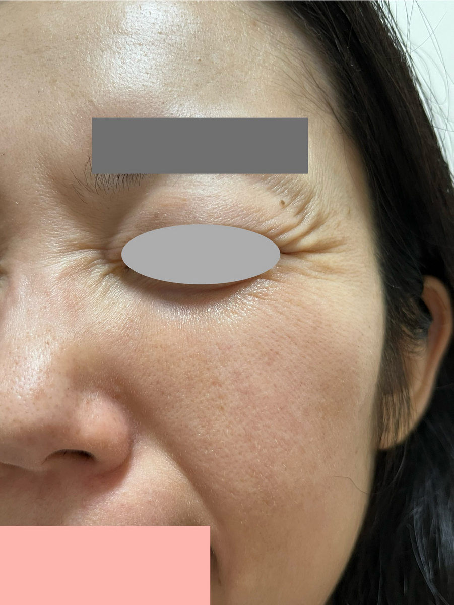 ゼオスキン  テーパリング　セラピューティック経過シワ