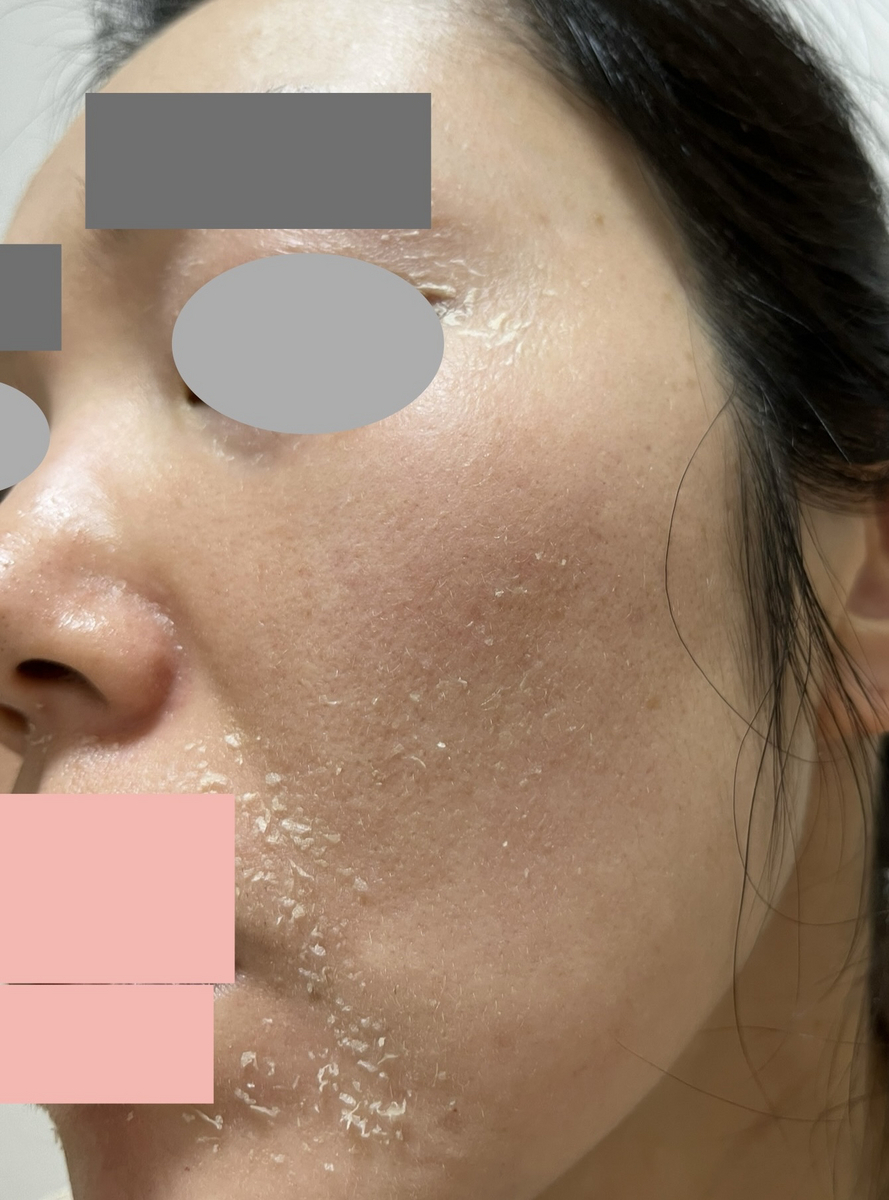 ゼオスキン  肝斑　消えない濃くなる　失敗　