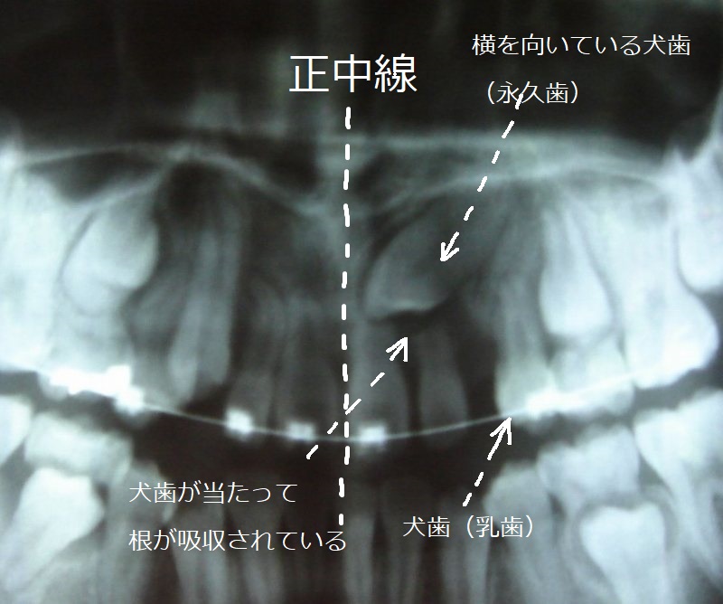 パントモ画像の図解。 パントモ画像の図解。