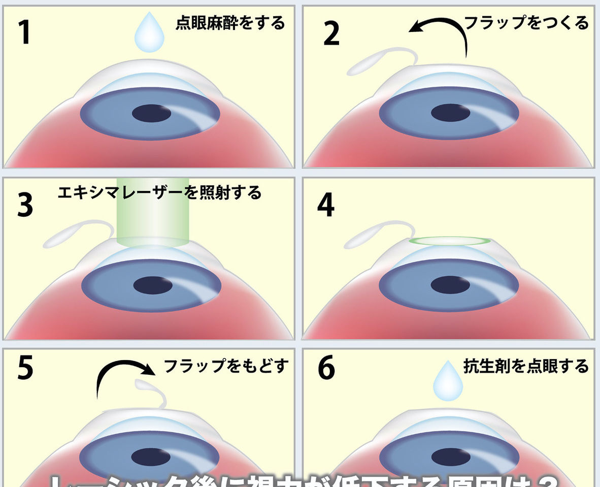 レーシック レーシックに失敗した体験談