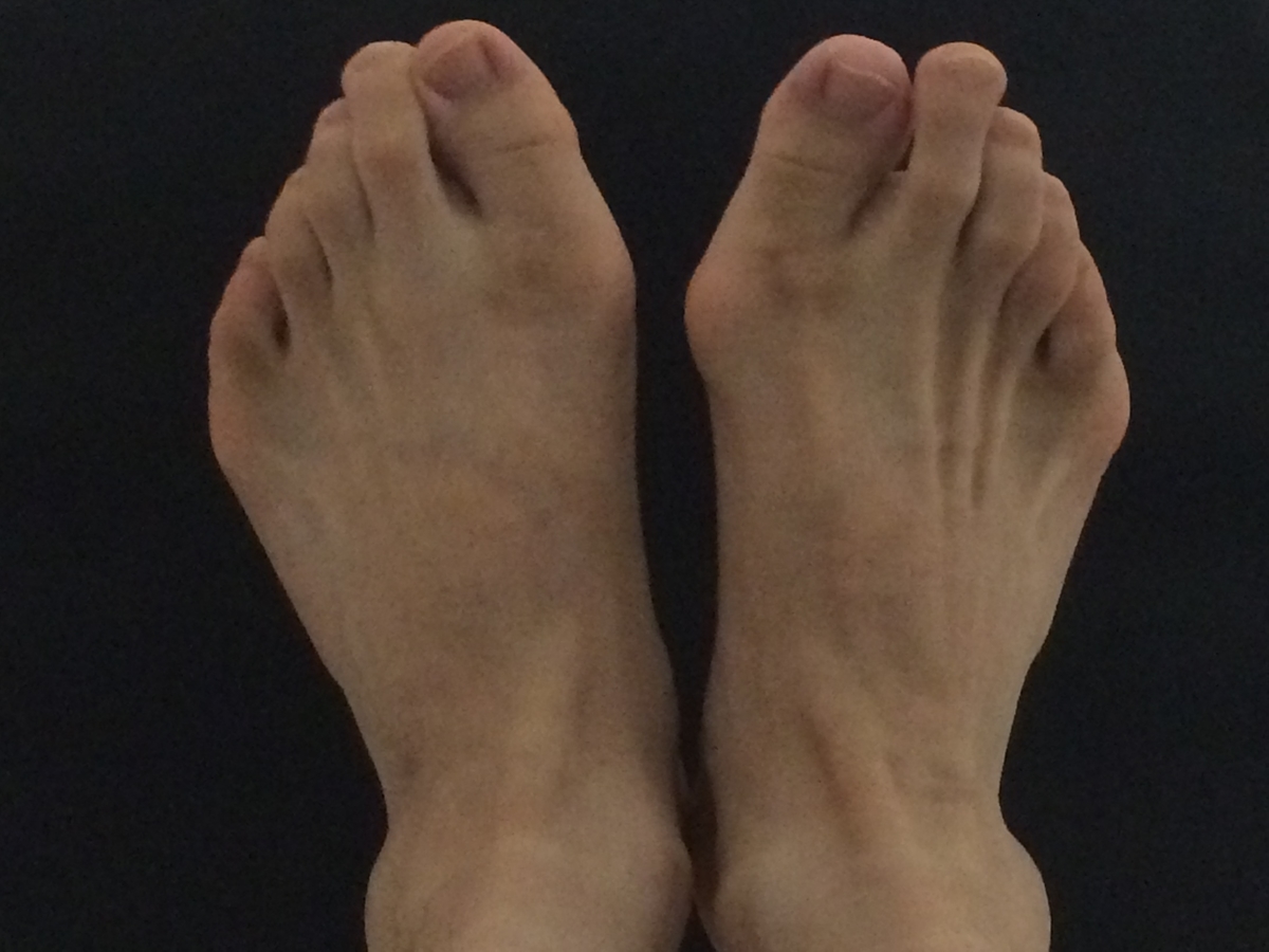 男の外反母趾治療 入院 Puttchey S Diary