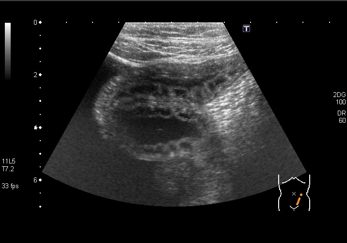 小腸アニサキス症のエコー像。小腸の浮腫と腹水。 らぴゅたった