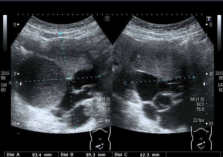 嚢胞性湿潤腫が形成される原因は何ですか?