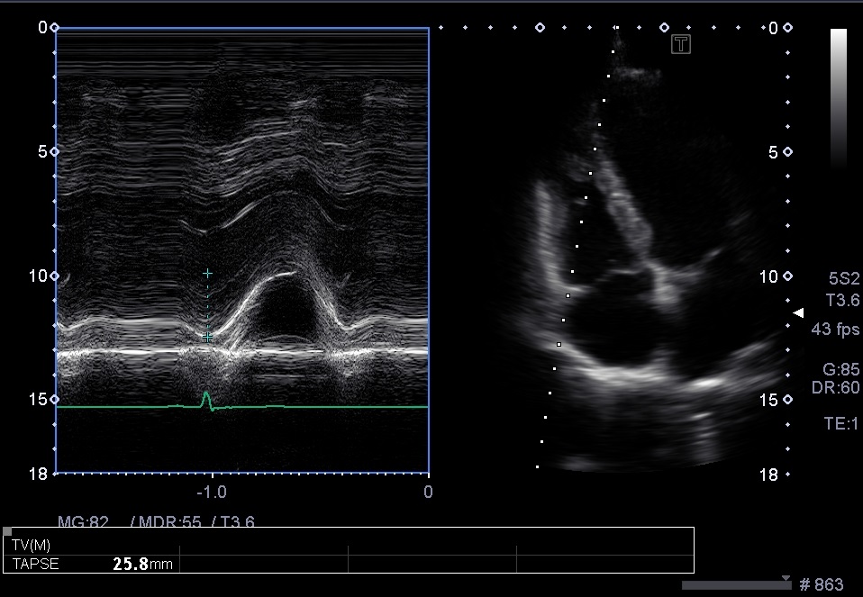 心エコー。右室収縮機能評価。TAPSEを測ってみよう！。三尖弁輪収縮期移動距離。 らぴゅたった