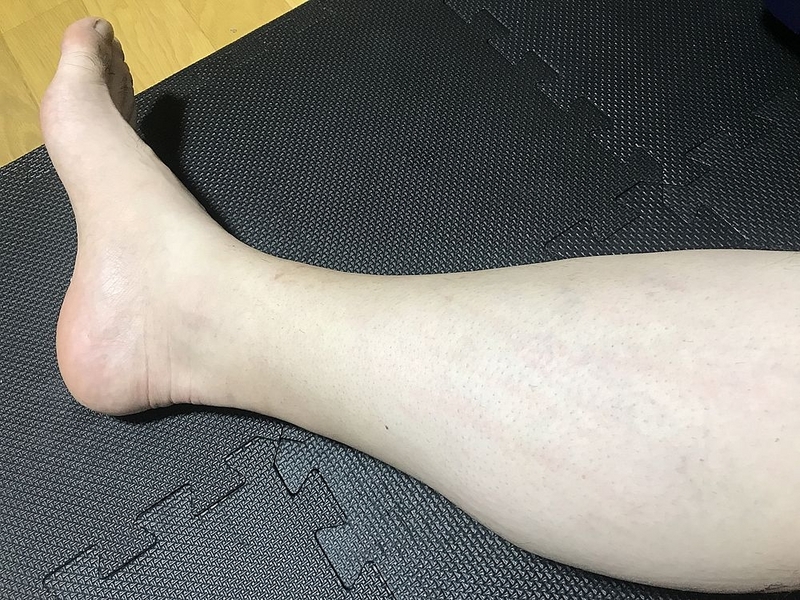 脱毛後　すね毛