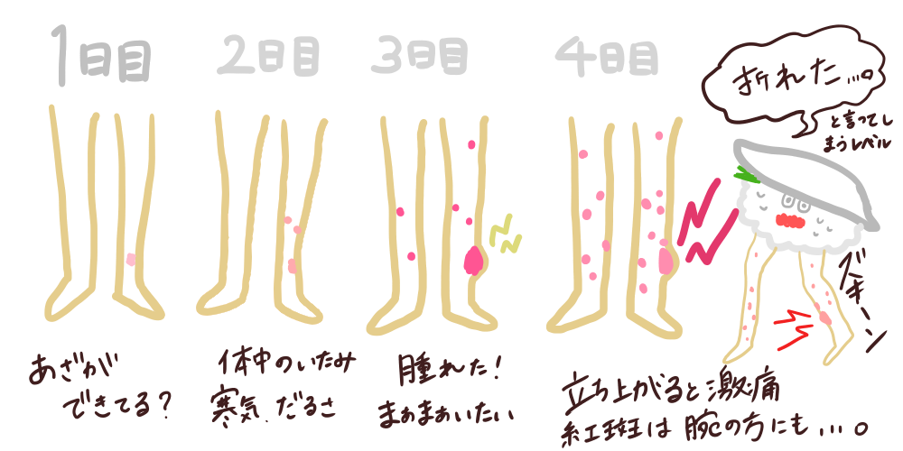 原因不明の結節性紅斑になった話 えんがわあぶり