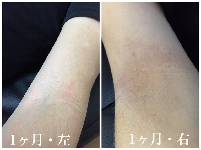 アトピー石鹸ひじ