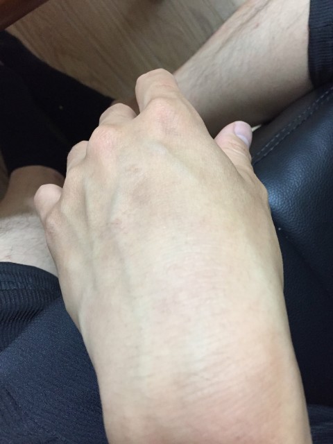 アトピー改善後手首