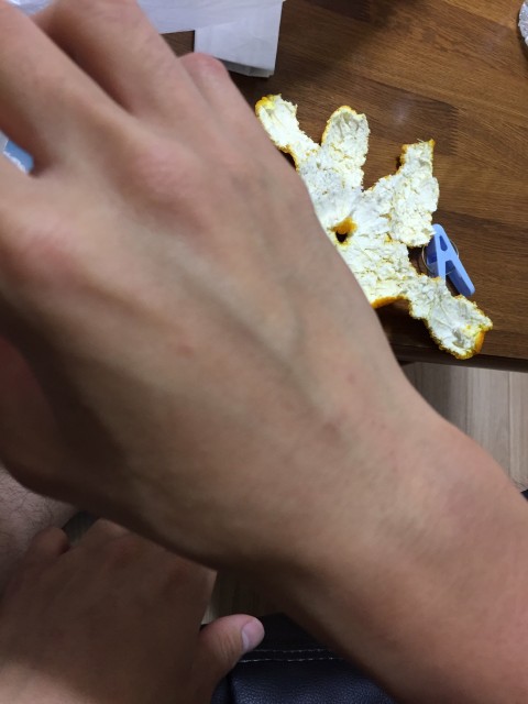 アトピー改善後手首
