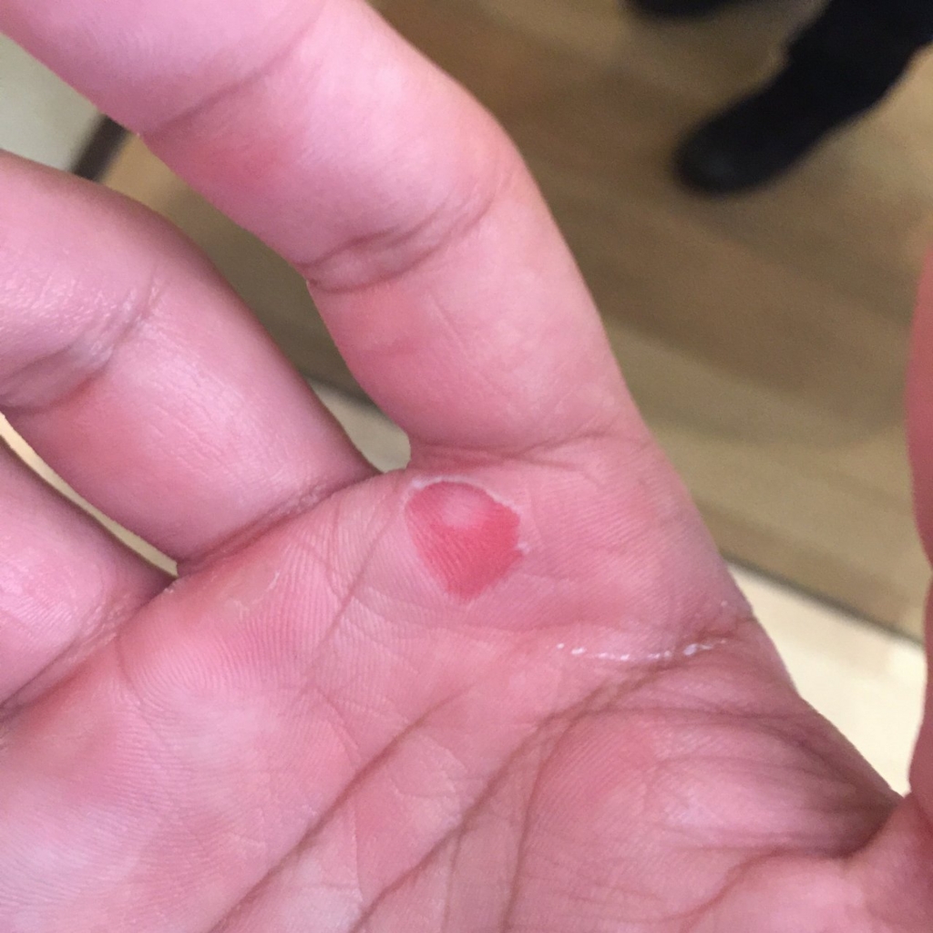 ボルダリングで指の皮がむけた…そんな時はキズパワーパッドを使って