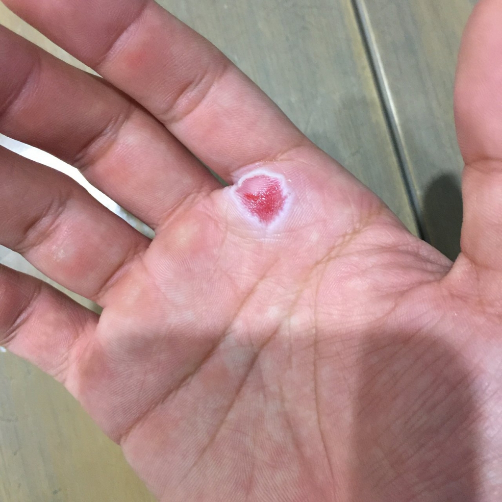 ボルダリングで指の皮がむけた…そんな時はキズパワーパッドを使って速く治そう！ POZNEN