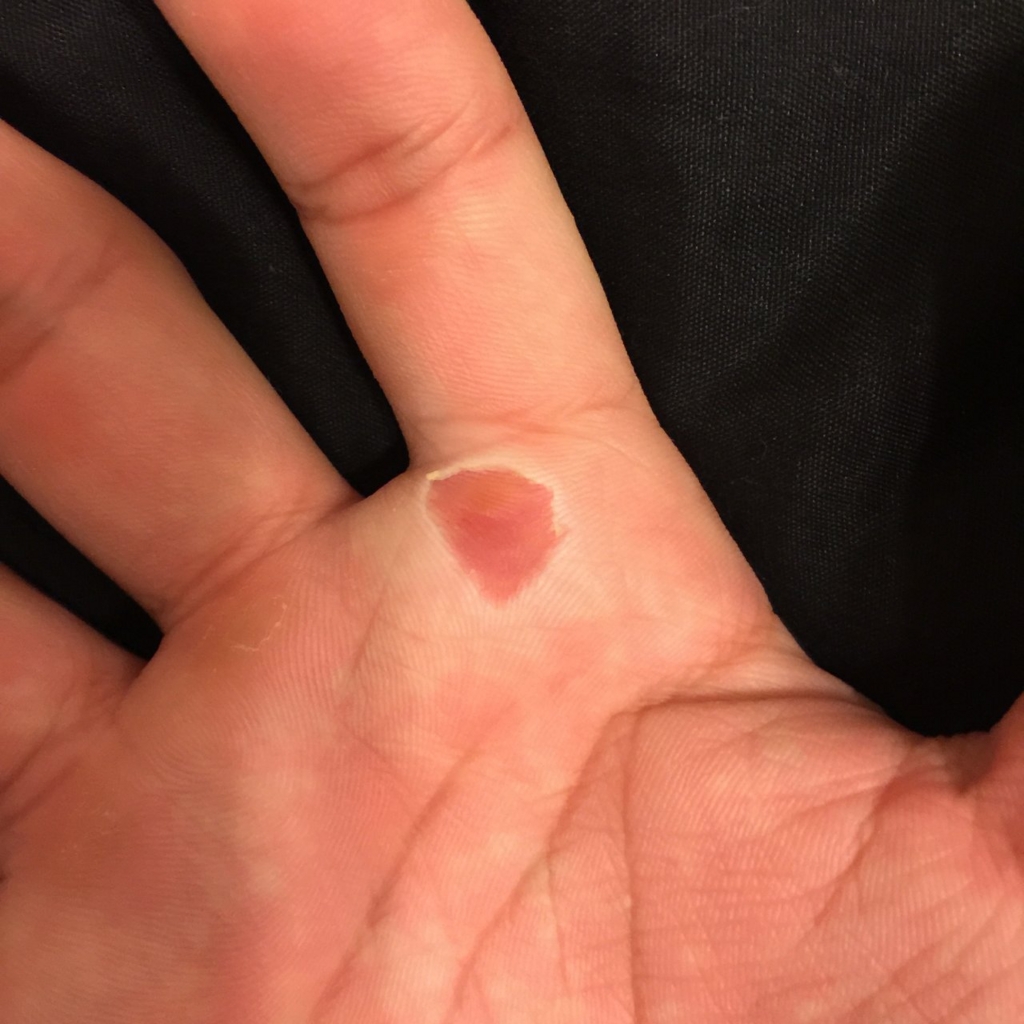 ボルダリングで指の皮がむけた そんな時はキズパワーパッドを使って速く治そう Poznen ボルダリングで指の皮がむけた そんな時はキズパワーパッドを使って速く治そう Poznen