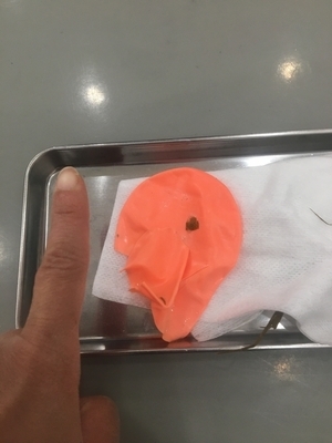 内視鏡で取った風船