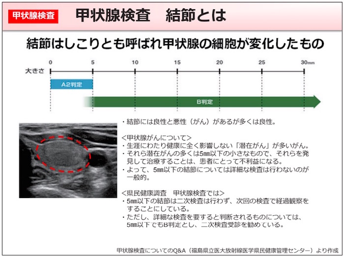 画像：甲状腺結節とは