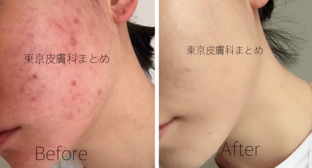 f:id:acneclinicinfo:20161012234106j:plain f:id:acneclinicinfo:20161012234106j:plain