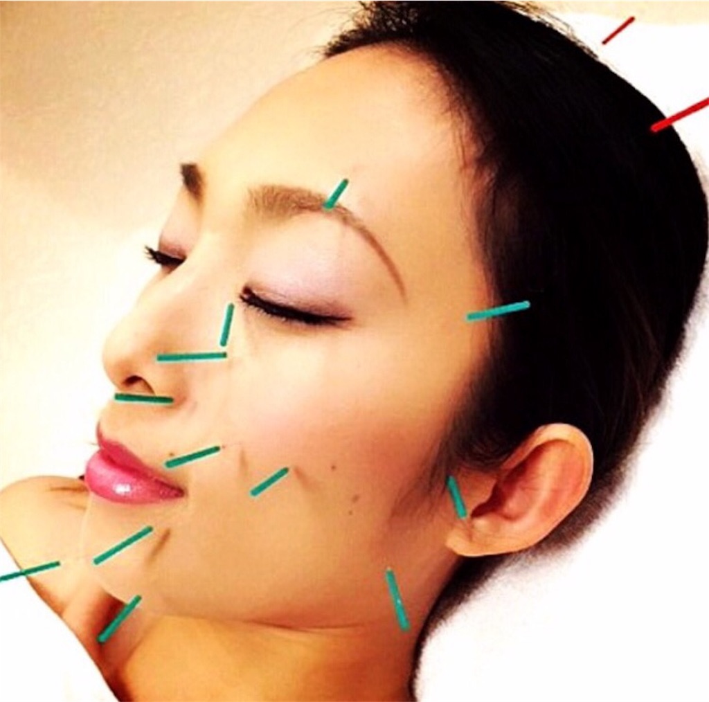 f:id:acupuncture_728199:20170824212753j:plain
