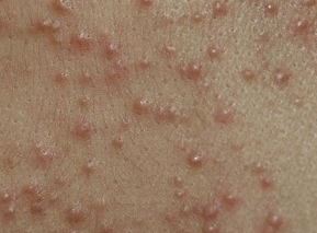 湿疹 と は 湿疹 皮膚炎の症状 原因 くすりと健康の情報局