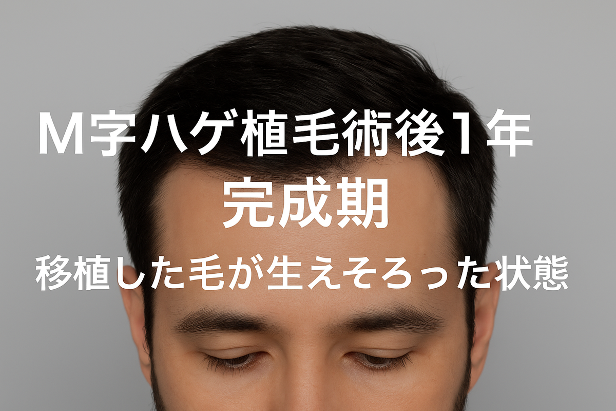 【M字ハゲ植毛術後1年】完成期（移植した毛のほぼ全てが生えそろい、長さも太さも既存の毛と完全になじんだ状態）の画像