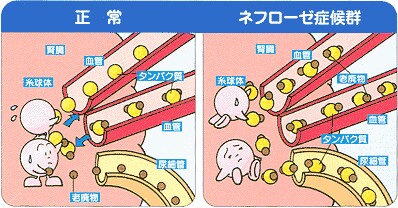 ネフローゼ 症候群 と は