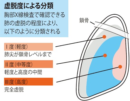 気胸(肺の虚脱) - 健康百科事典