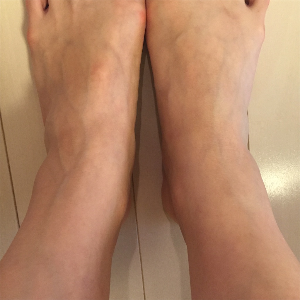 現役バスケ選手に聞いた足首のねんざの応急処置 アキえり