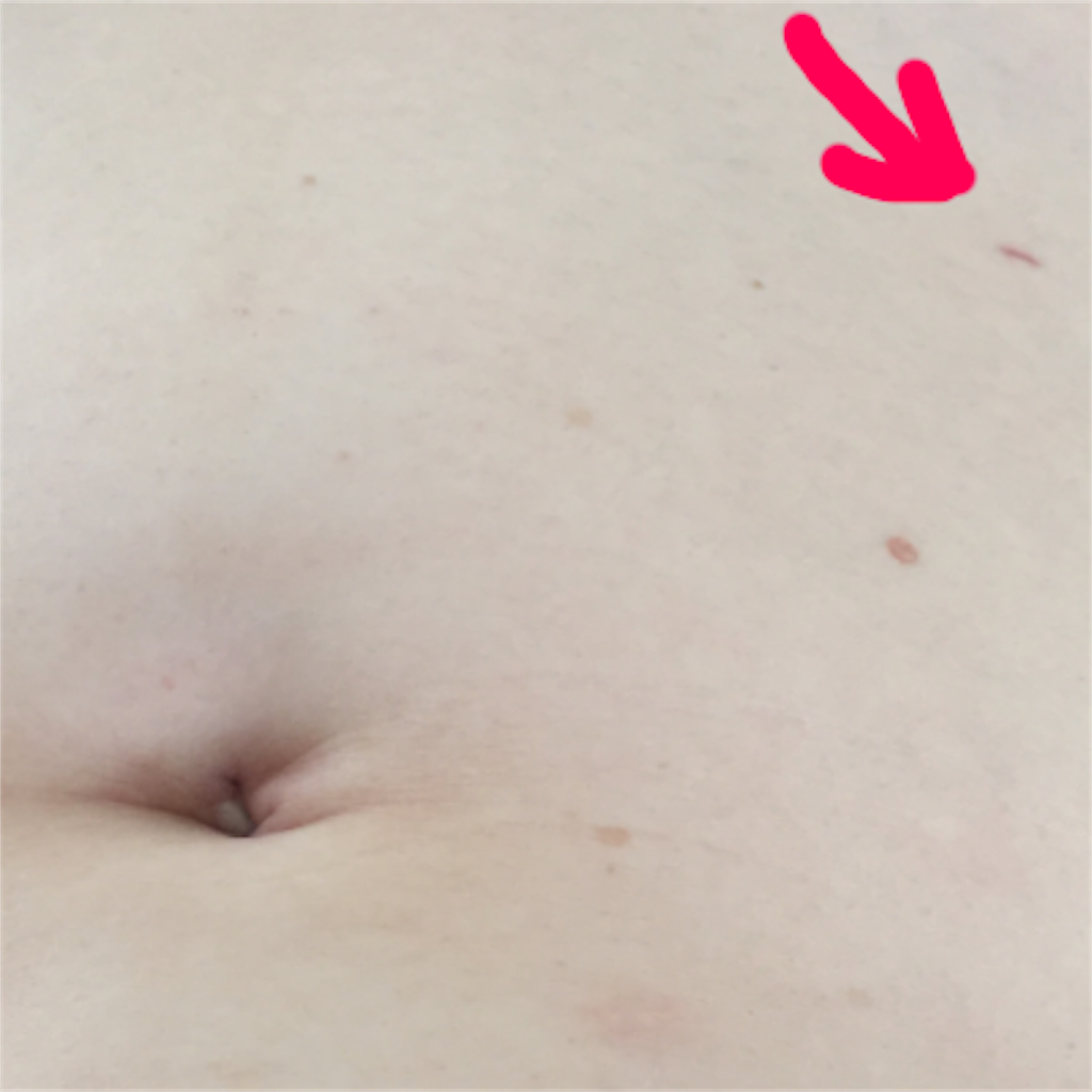 計画的に虫垂炎 盲腸 の手術をしました 気になる手術跡は アキえり