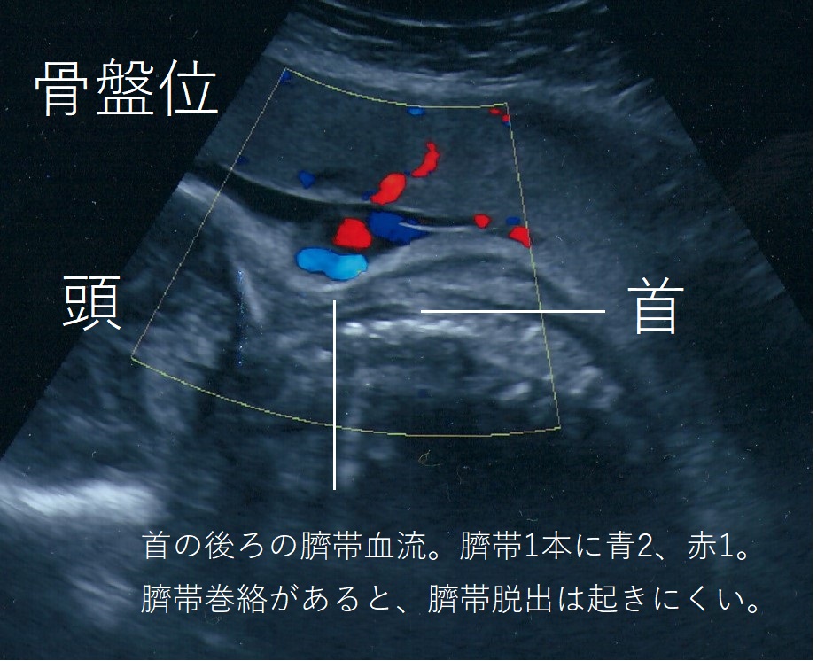 臍帯巻絡 さいたいけんらく 妊娠 出産 情報百科 臍帯巻絡 さいたいけんらく 妊娠 出産 情報百科