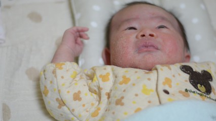 「薬を使いたくないし、自然治癒に任せよう」と思った乳児湿疹。でも早めに受診すれば良かったかも…