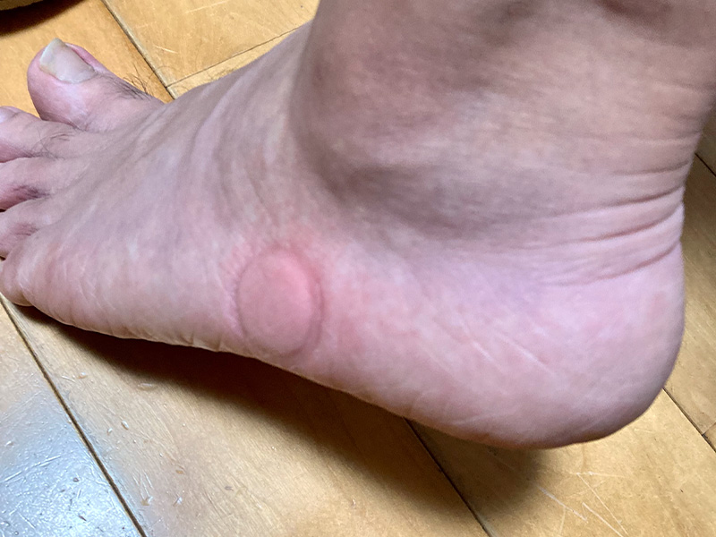 ムカデ刺され直後にポイズンリムーバー使用