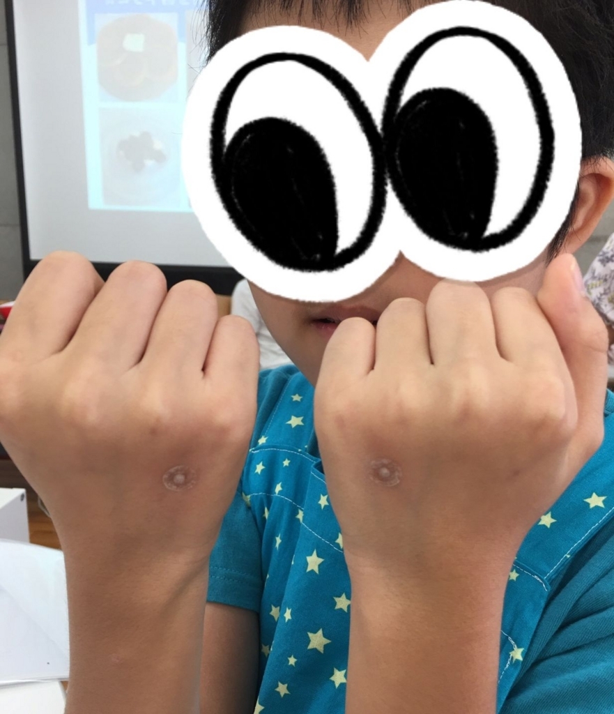 f:id:allergy_nagasakikko:20170820210350j:plain