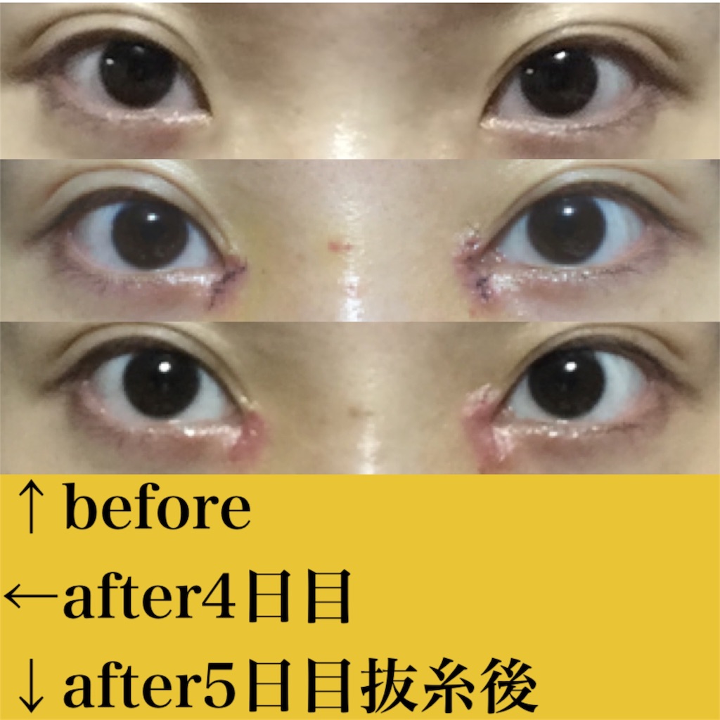 ダウンタイム5日目 抜糸 目頭切開 クレヴィエル経過ブログ