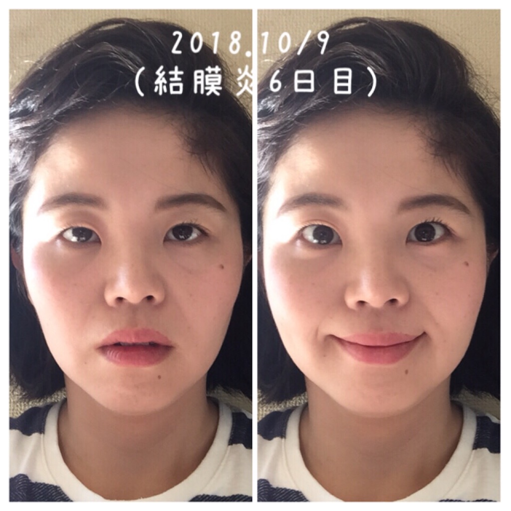 18 10 9 結膜炎6日目 顔ヨガのある生活 18 10 9 結膜炎6日目 顔ヨガのある生活