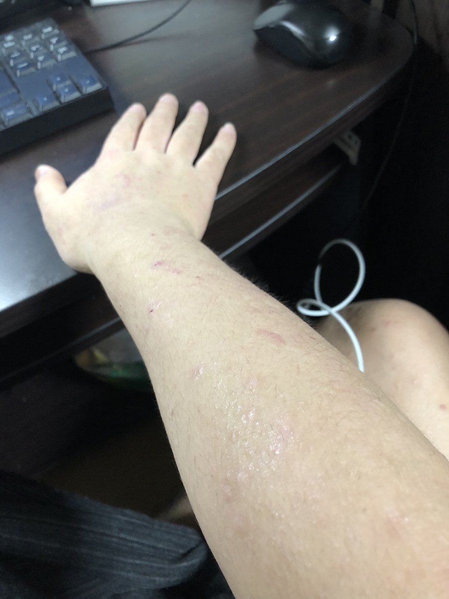 酷いアトピーだった私が2週間マグネシウム風呂に入った結果 衝撃の変化が 貧弱引きこもりの呟き