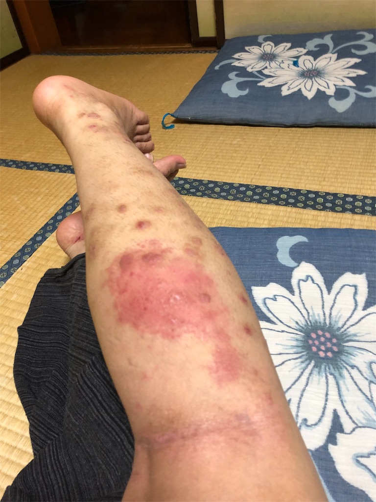 数年ぶりに虫に刺されたらとんでもなく腫れた話 貧弱引きこもりの呟き 数年ぶりに虫に刺されたらとんでもなく腫れた話 貧弱引きこもりの呟き