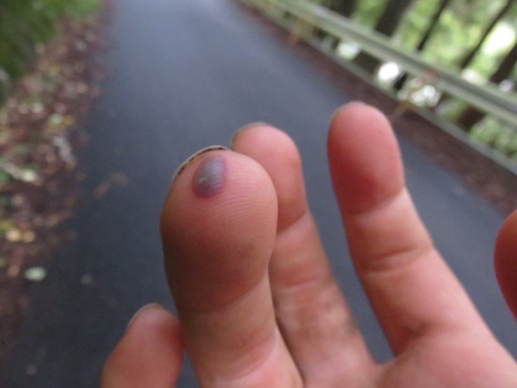 ヤマビルに引っ付いてしまい吸われ