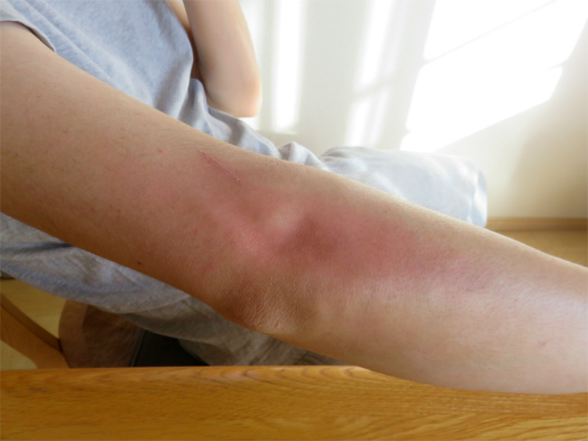 f:id:aohige0718:20180519144923j:plain 虫に吸われた