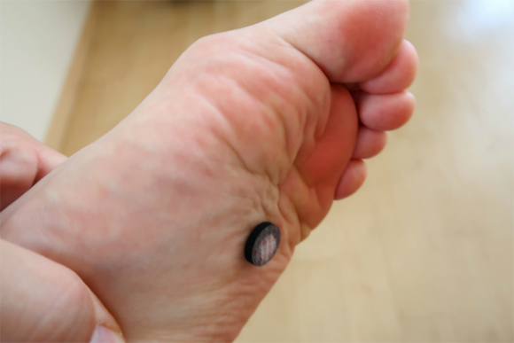 足の裏にもシッカリとお灸を貼れた