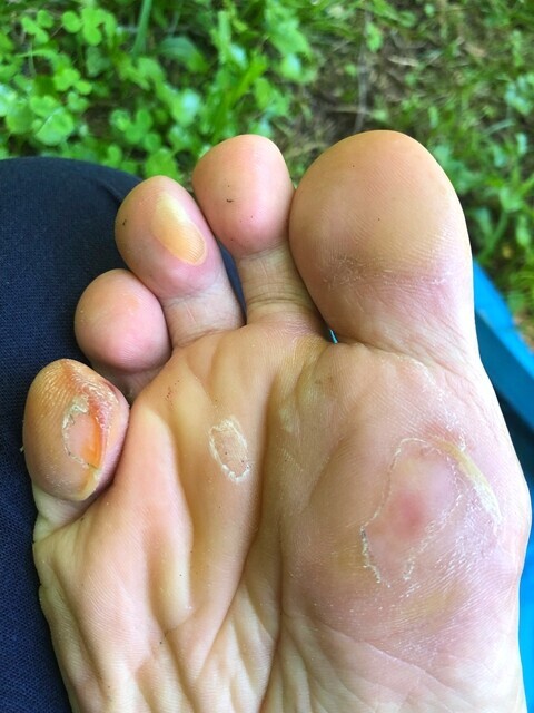 芦別岳へ登山した後の足裏の様子