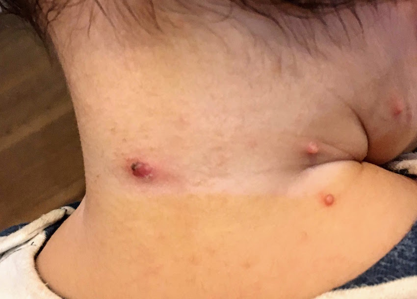 水いぼ治療開始から３週間 はっきりとした変化がありました 可愛い子たちと旅をせよ