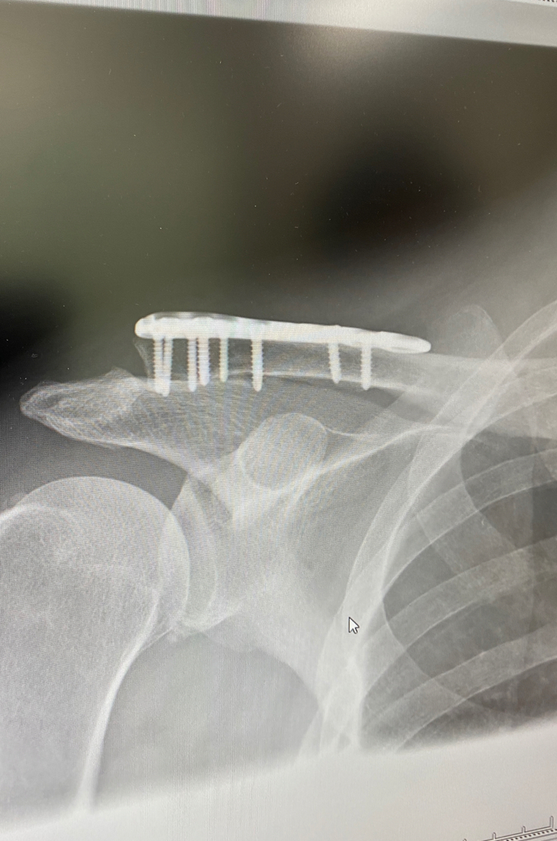 鎖骨骨折の手術費用 結構なお値段でした あおぞらごはん