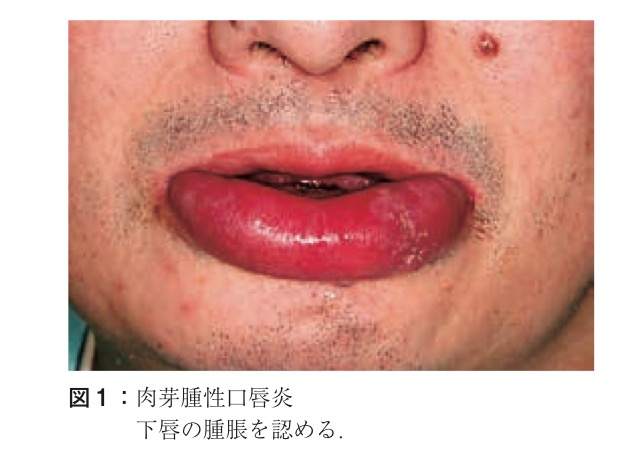 肉芽腫とは何ですか?