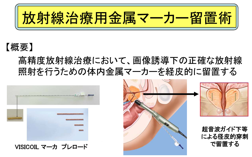 陽子線治療は他の前立腺がん治療と比べてどうですか?
