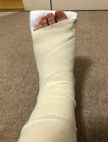 まさかの足骨折 桜庭あさみのつぶやき