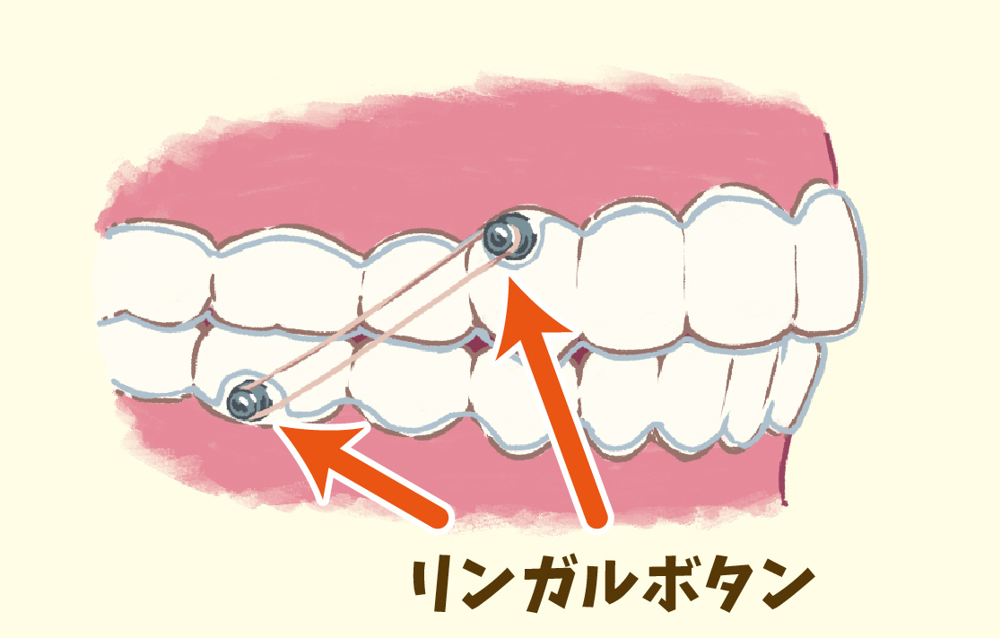 リンガルボタン
