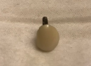 元旦に抜けたセラミックの歯