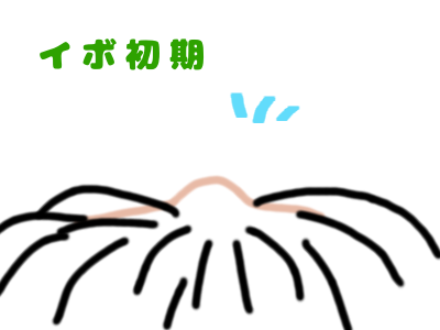 頭にイボができるから 頭にイボができるから