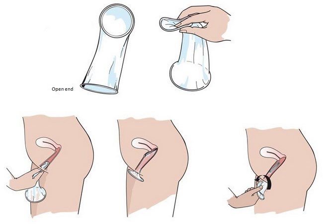 bao cao su nữ dùng như thế nào