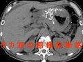 スキルス胃癌の石灰化 　腹部CT