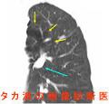 気管支閉鎖症　胸部CT